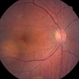 Non -Small-Cell Lung Ca  Choroidal Meta OD Fundus Non -Small-Cell Lung Ca  Choroidal Meta OD Fundus
